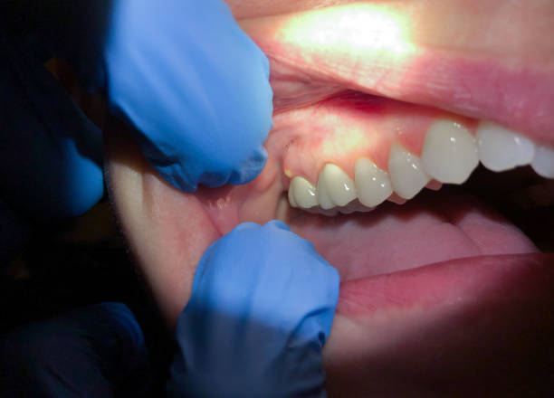 Best Emergency Dental Care for Broken or Chipped Teeth in Stanley, ND
