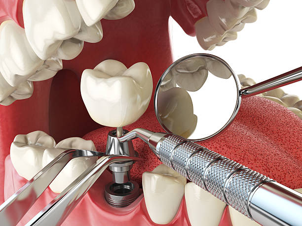 Best Emergency Dental Care for Broken or Chipped Teeth in Stanley, ND